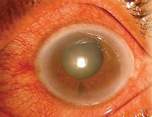 Acute Attack (Mid-dilated pupil)
