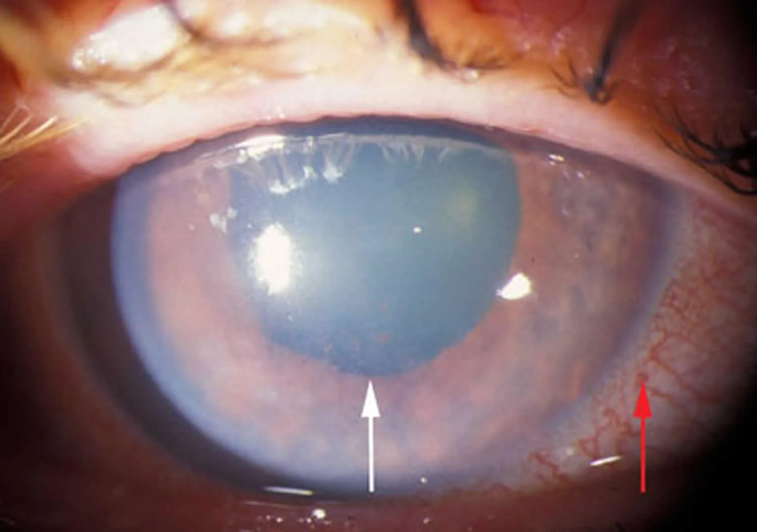 Steamy Cornea (Corneal Edema)
