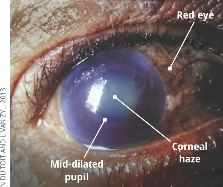 Corneal Edema
