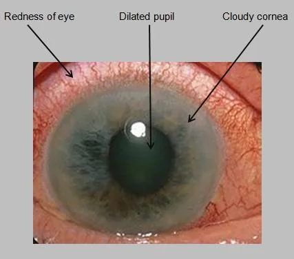 Acute Angle-Closure Glaucoma
