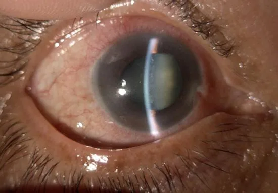 Acute Angle-Closure Glaucoma (Presentation)