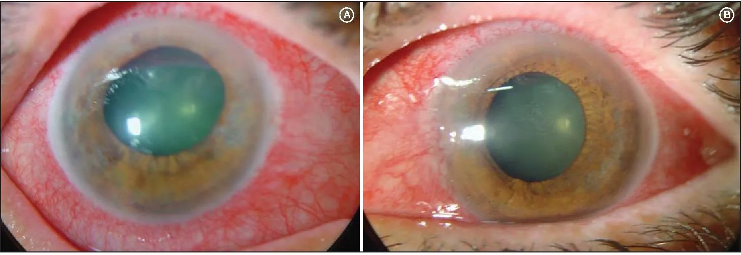 Acute Angle-Closure Glaucoma (Bilateral view)
