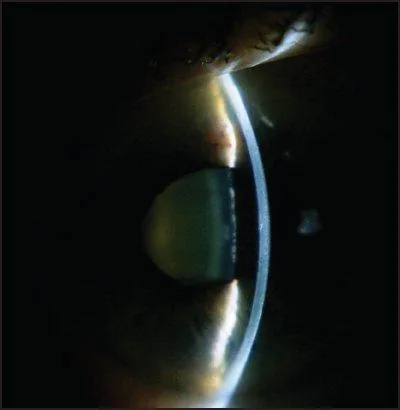 Gonioscopy (Closed Angle)