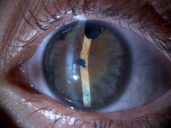 Shallow Anterior Chamber (Iris Bombé)