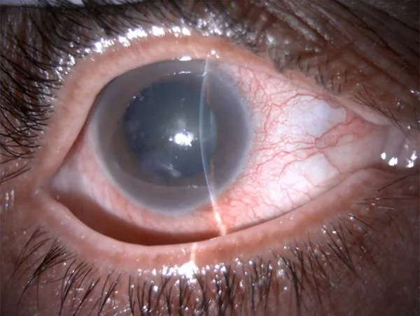 Shallow Anterior Chamber