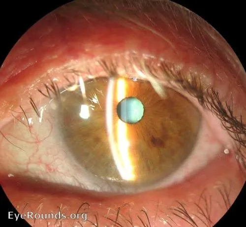 Shallow Anterior Chamber (Slit lamp)