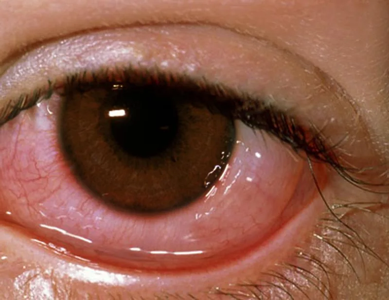 Allergic Conjunctivitis (Watery discharge)