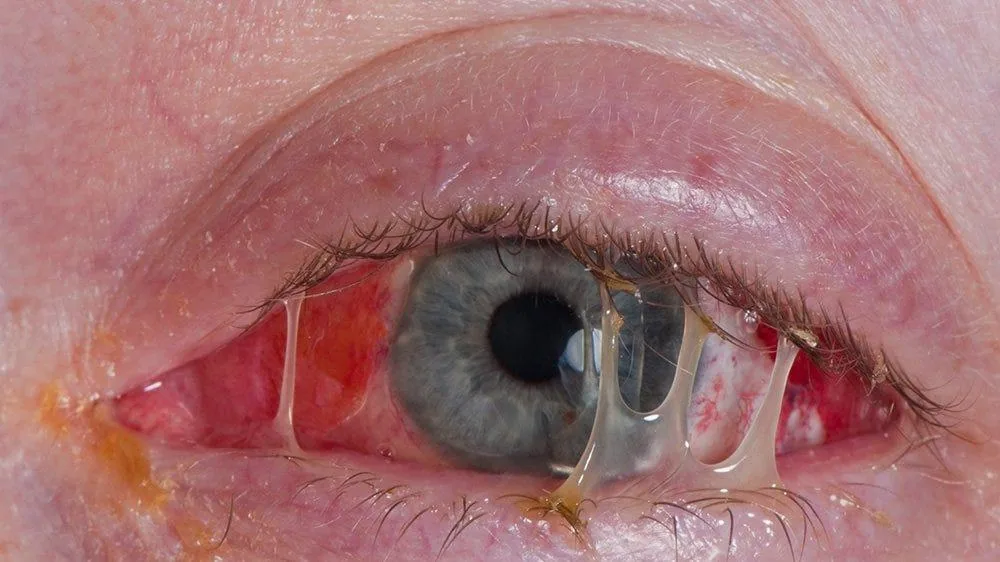 Bacterial Conjunctivitis (Crusting of eyelashes)