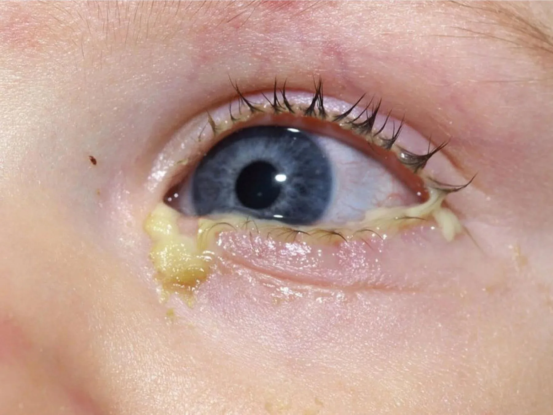 Bacterial Conjunctivitis (Mucopurulent discharge)