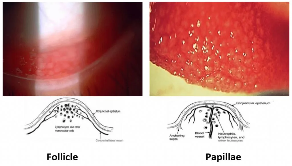 Follicles (Viral) vs Papillae (Bacterial/Allergic)