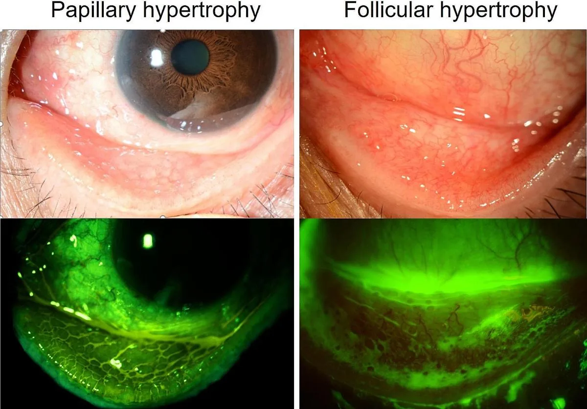 Follicular vs Papillary Reaction (Clinical Comparison)