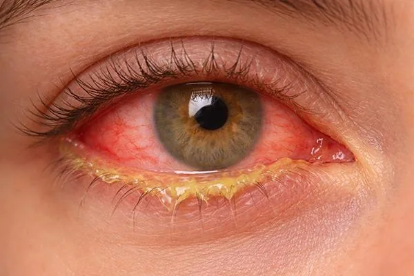 Acute Conjunctivitis (Watery/mucoid discharge)