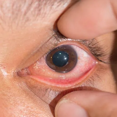 Acute Conjunctivitis (Eyelid edema)