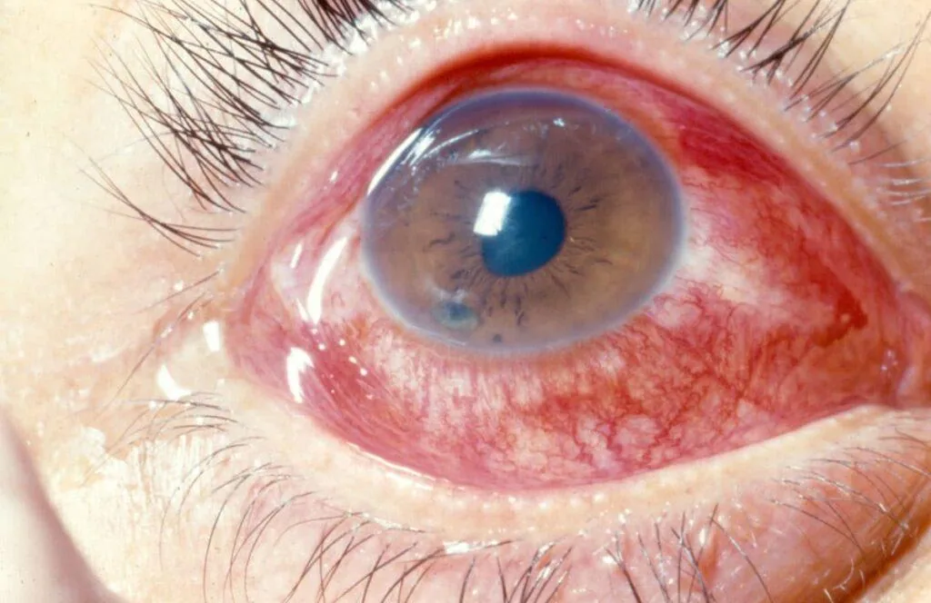 Acute Conjunctivitis (Clinical presentation)