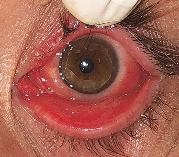 Hyperacute Gonococcal Conjunctivitis (Profuse hyperpurulent discharge)