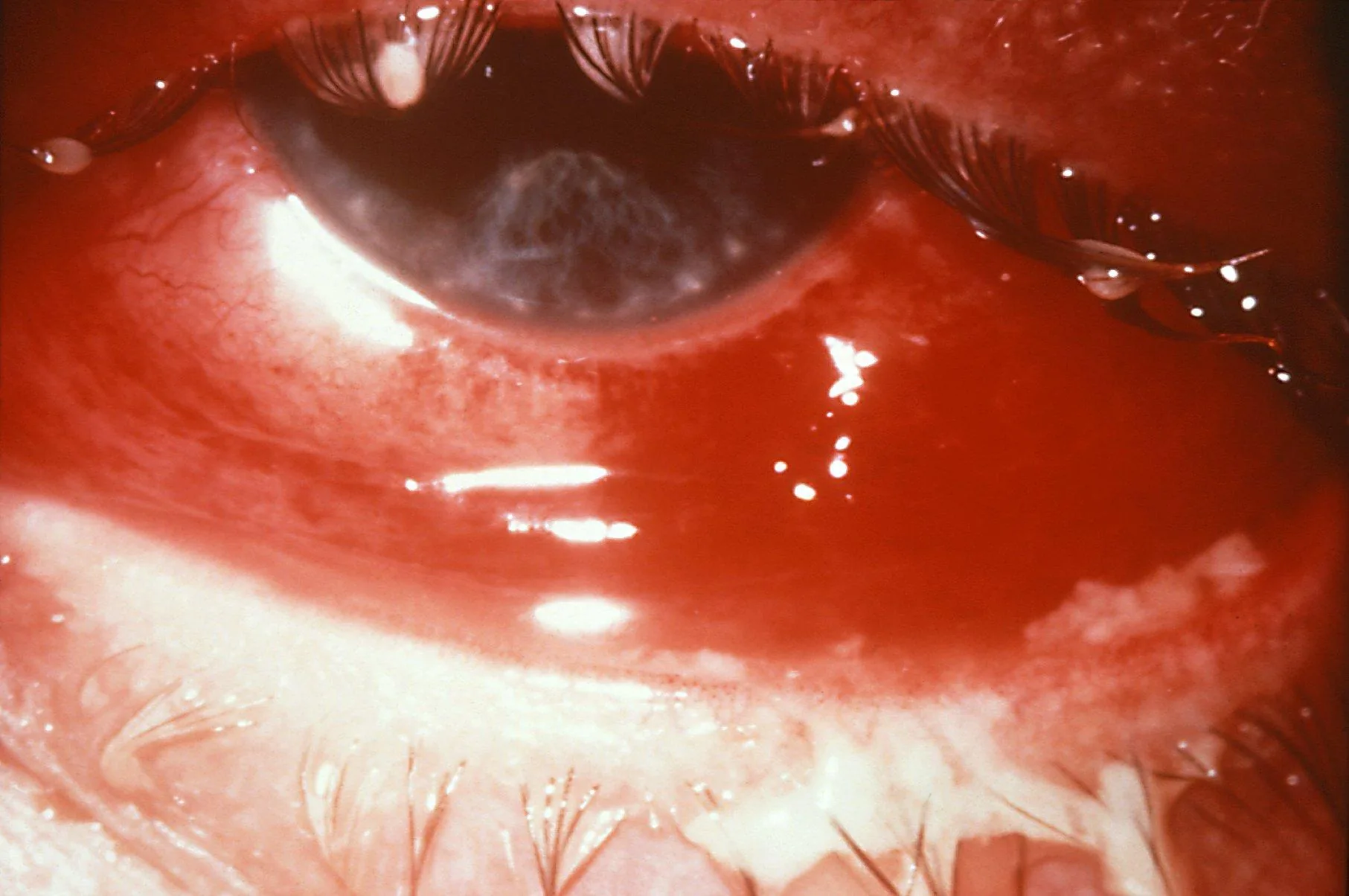 Hyperacute Conjunctivitis (Marked eyelid edema)