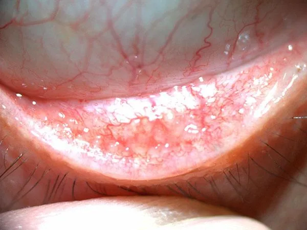 Viral Conjunctivitis (UIowa EyeRounds - External)
