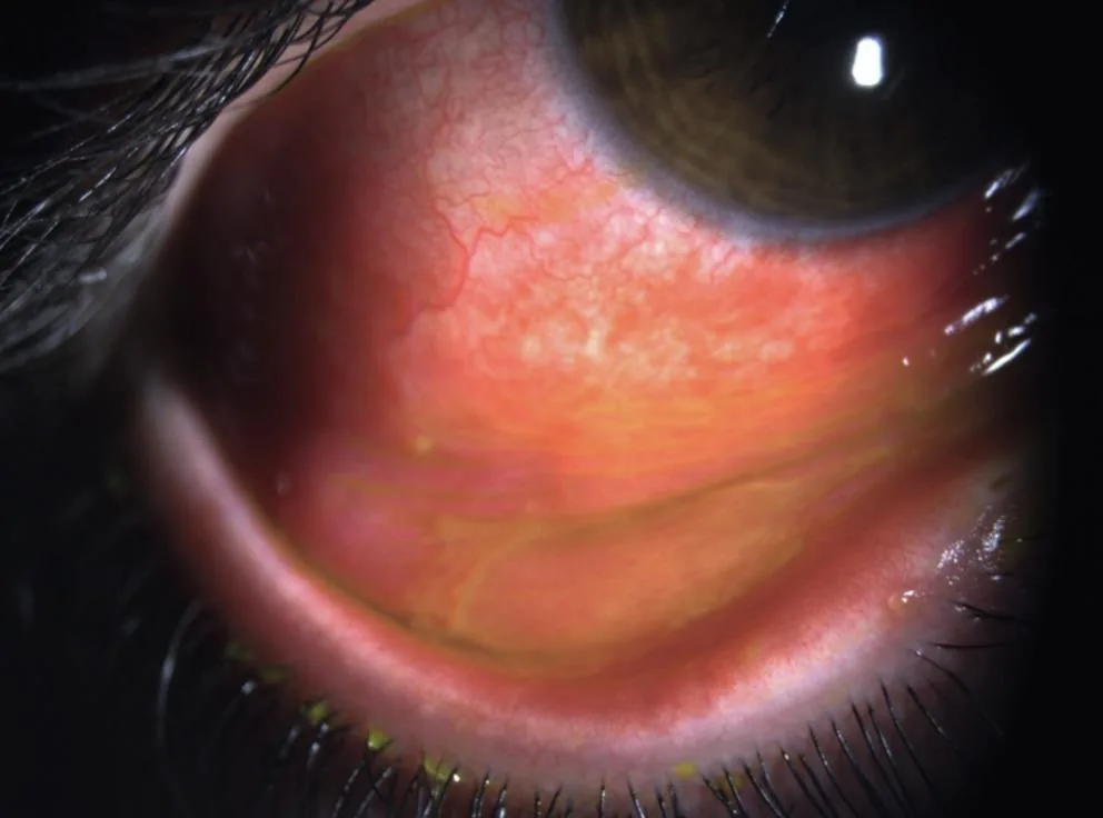 Viral Conjunctivitis (UIowa EyeRounds - Slit lamp)