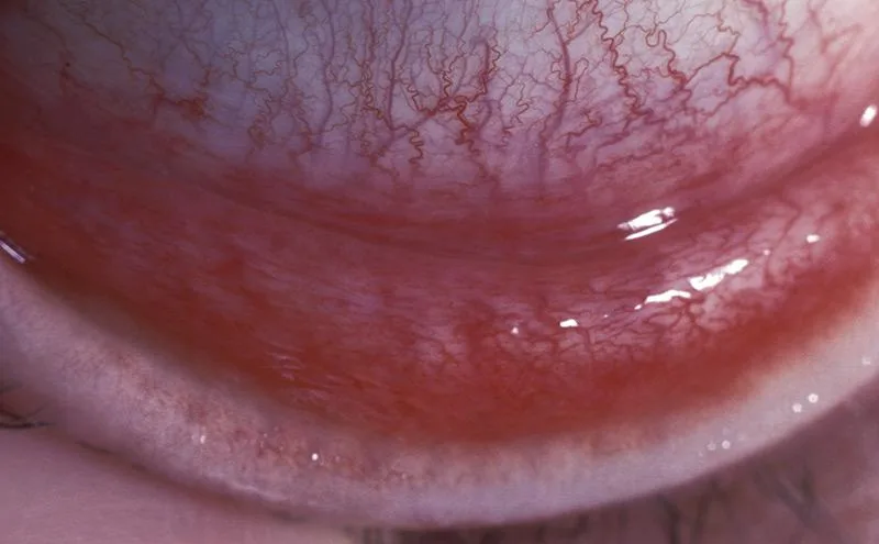 Viral Conjunctivitis (UIowa EyeRounds - Follicles)