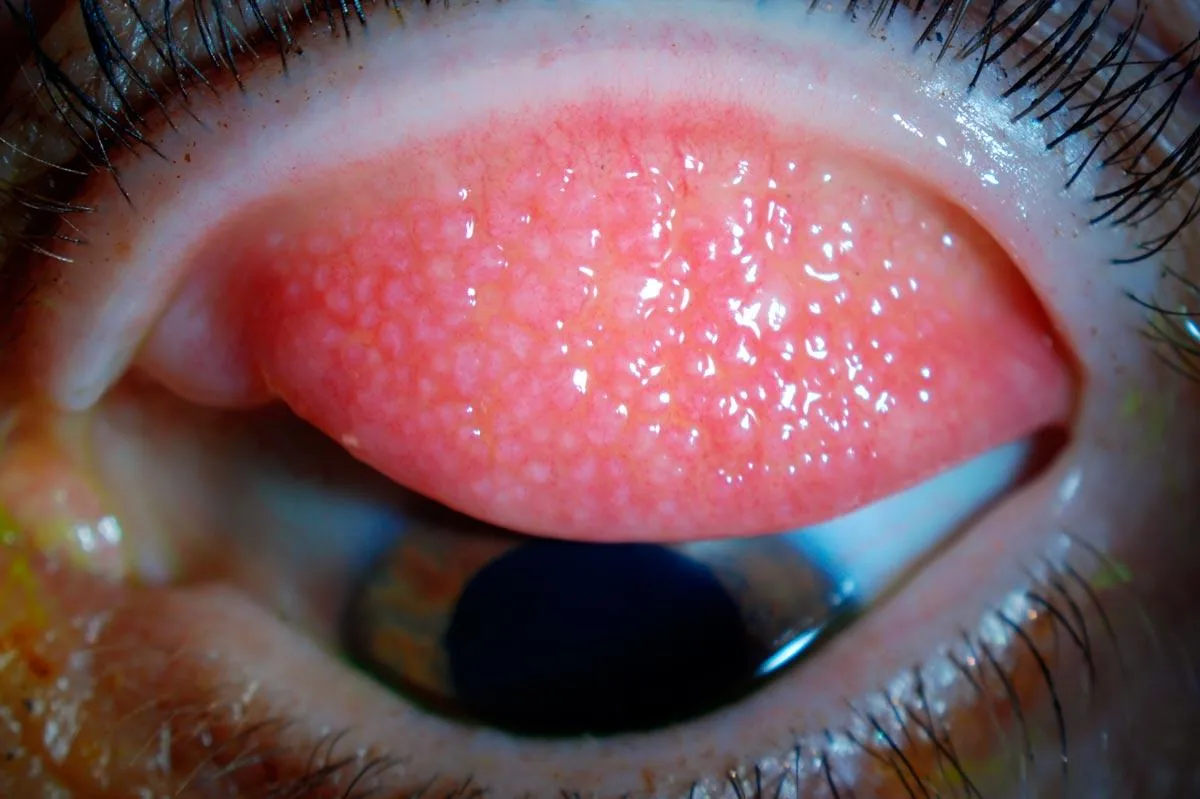 Viral Conjunctivitis (UIowa EyeRounds - Lymphadenopathy)