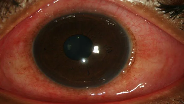 Adenoviral Conjunctivitis (Hyperemia & chemosis)