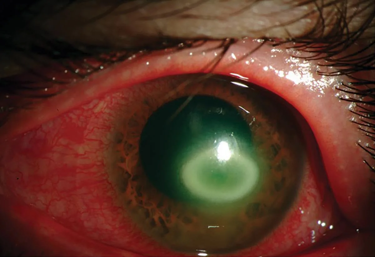 Acanthamoeba Keratitis (Clinical view)