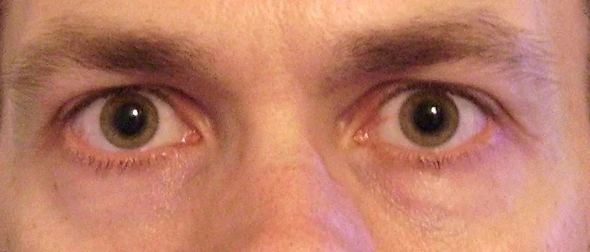 Bilateral Adie (tonic) pupils