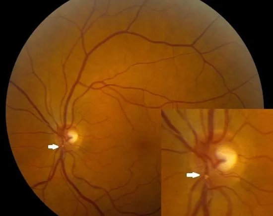 Multiple Retinal Emboli