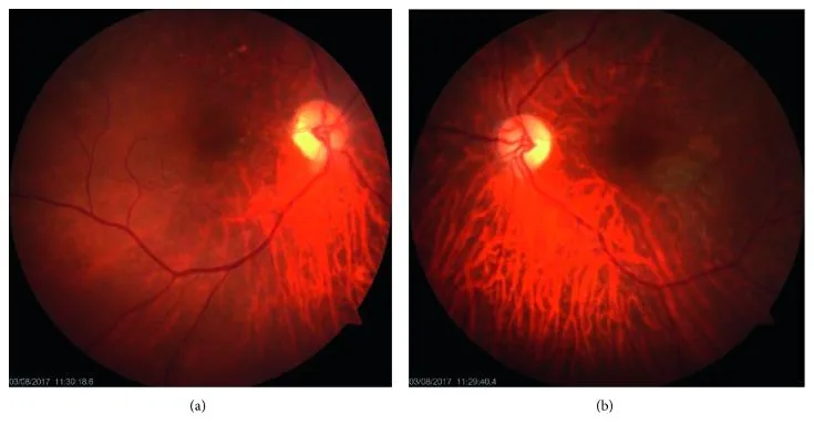 Giant Cell Arteritis - Pallid optic disc edema
