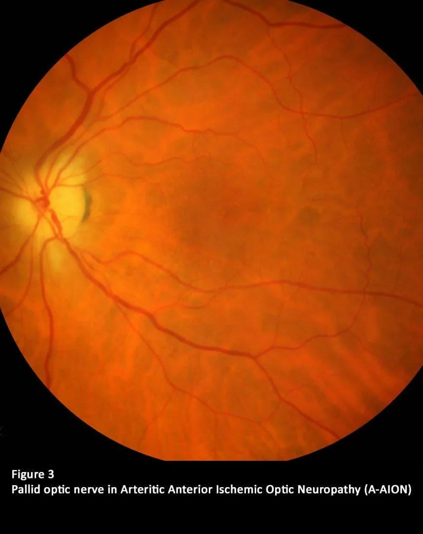 Giant Cell Arteritis - Fundus examination