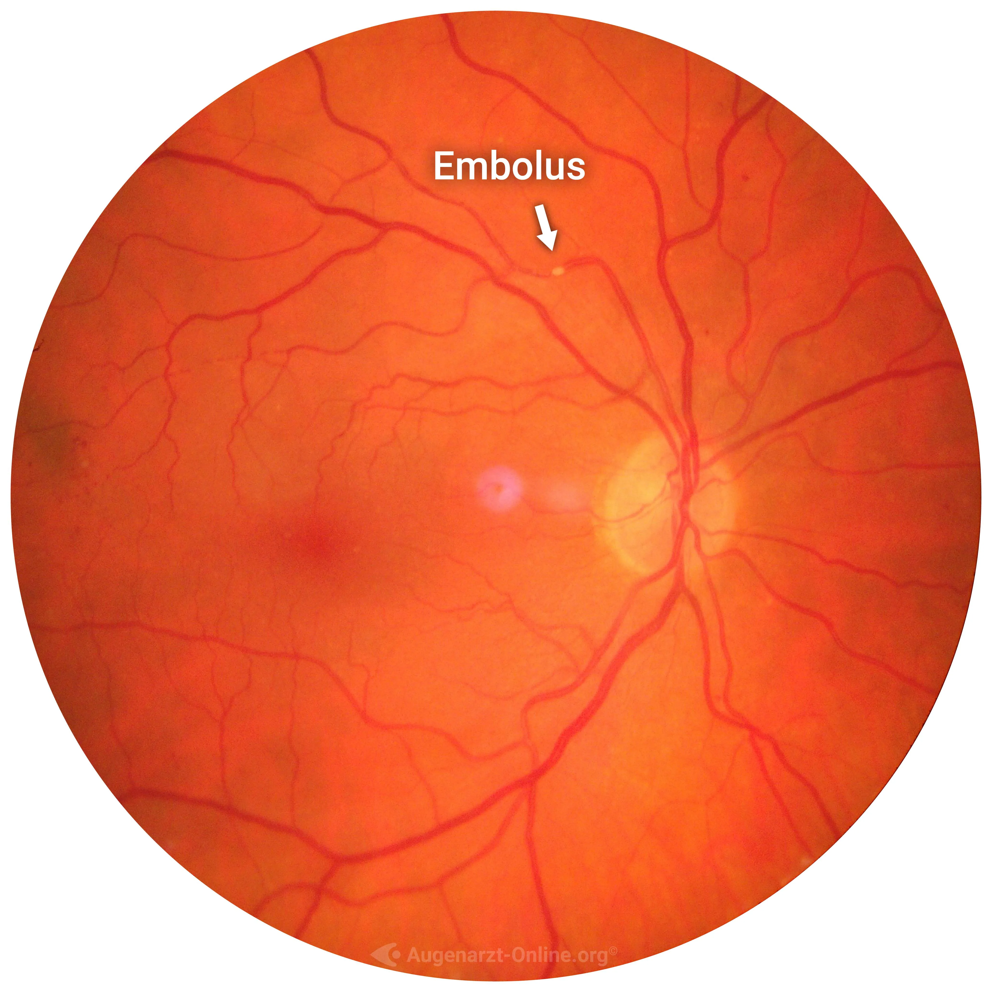 Hollenhorst Plaque (Cholesterol embolus)
