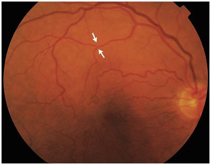 Cholesterol embolus within retinal arteriole