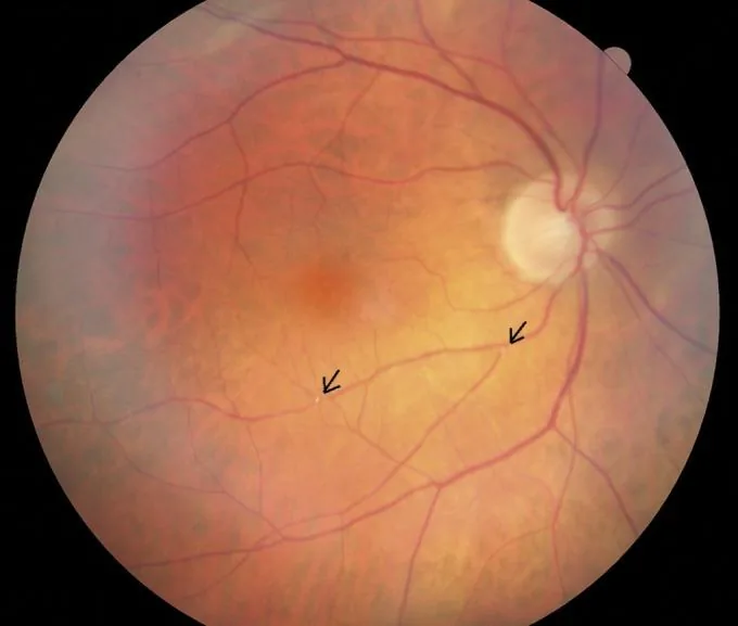 Hollenhorst Plaque with Pale Retina (Ischemia)