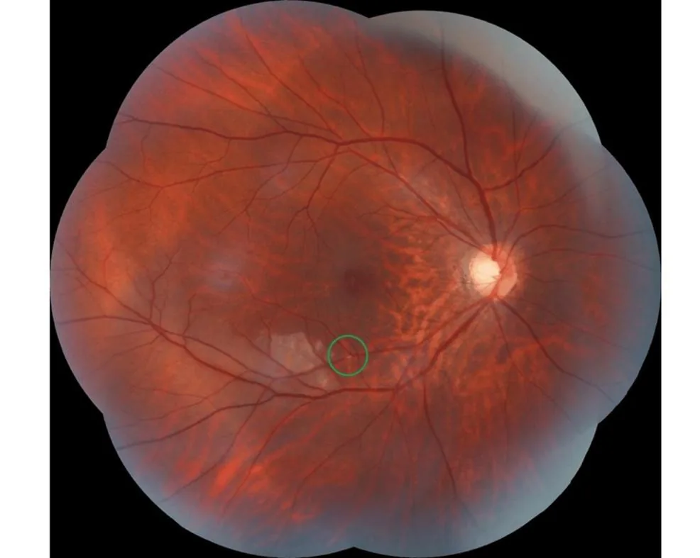 Embolus with surrounding ischemic pale retina