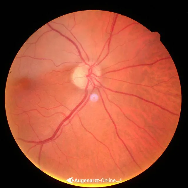 Pale retina highlighting poor perfusion