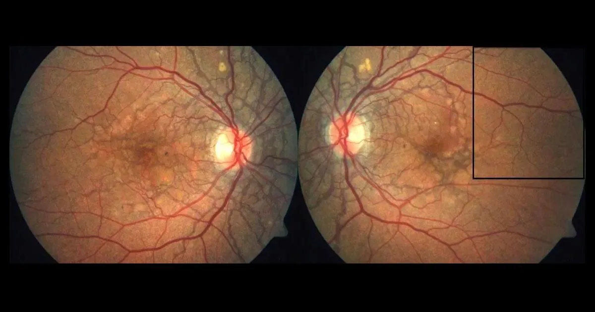 Angioid Streaks in Pseudoxanthoma Elasticum (PXE)