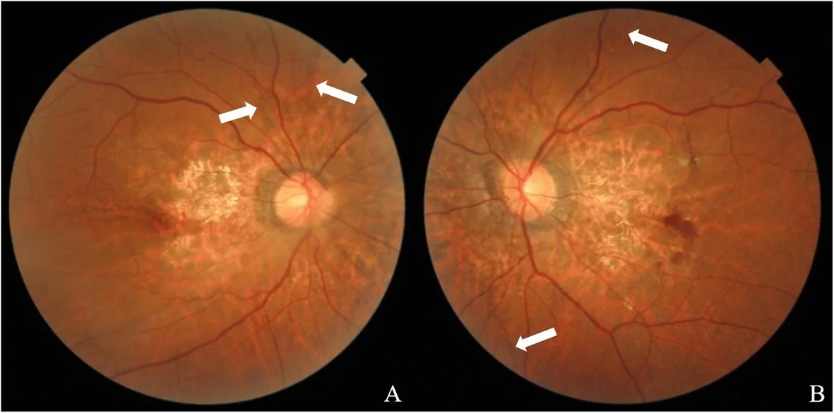 Irregular linear crack-like dehiscences in Bruch's membrane