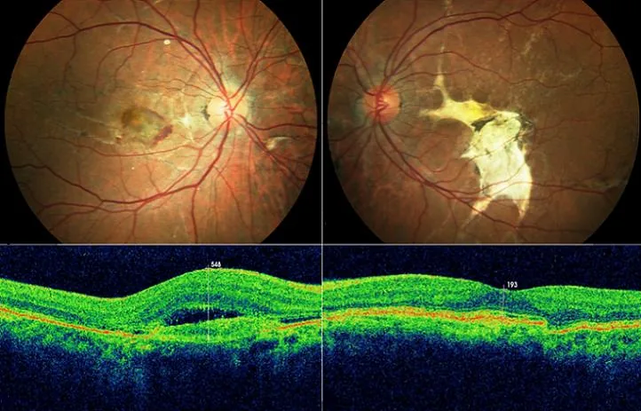 Macular involvement and CNV