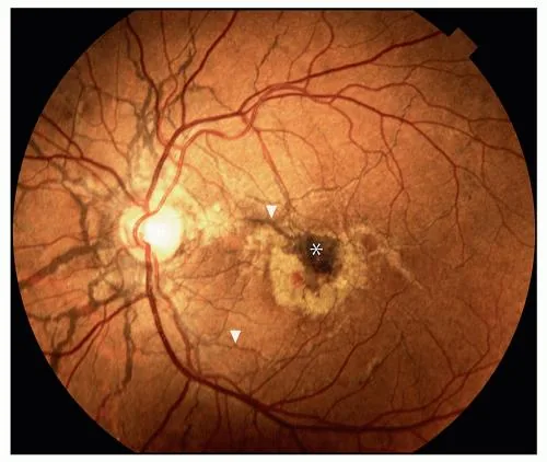 Active Choroidal Neovascularization