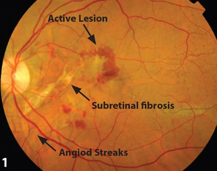 CNV scarring and macular damage