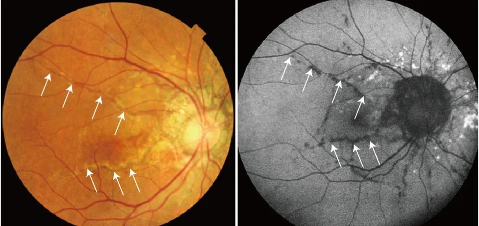 Bruch's membrane disruptions on OCT