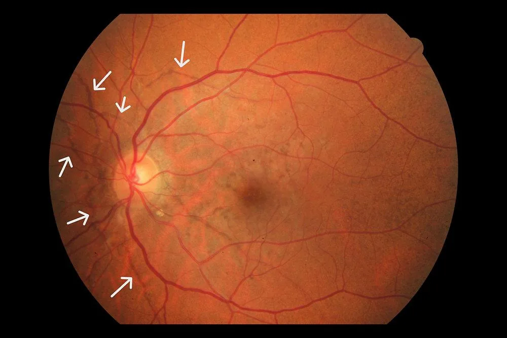 Peau d'Orange (Mottled fundus appearance)