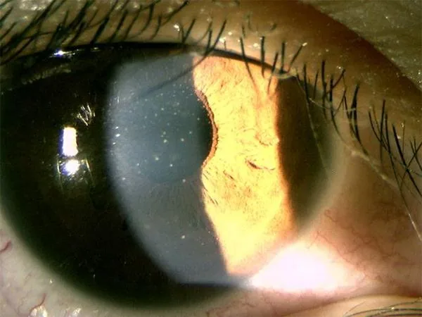 Anterior Chamber Cells and Flare (Slit lamp beam)