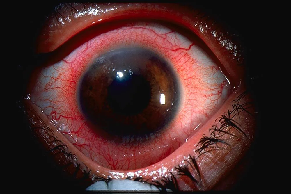 Active inflammation with cells in the anterior chamber