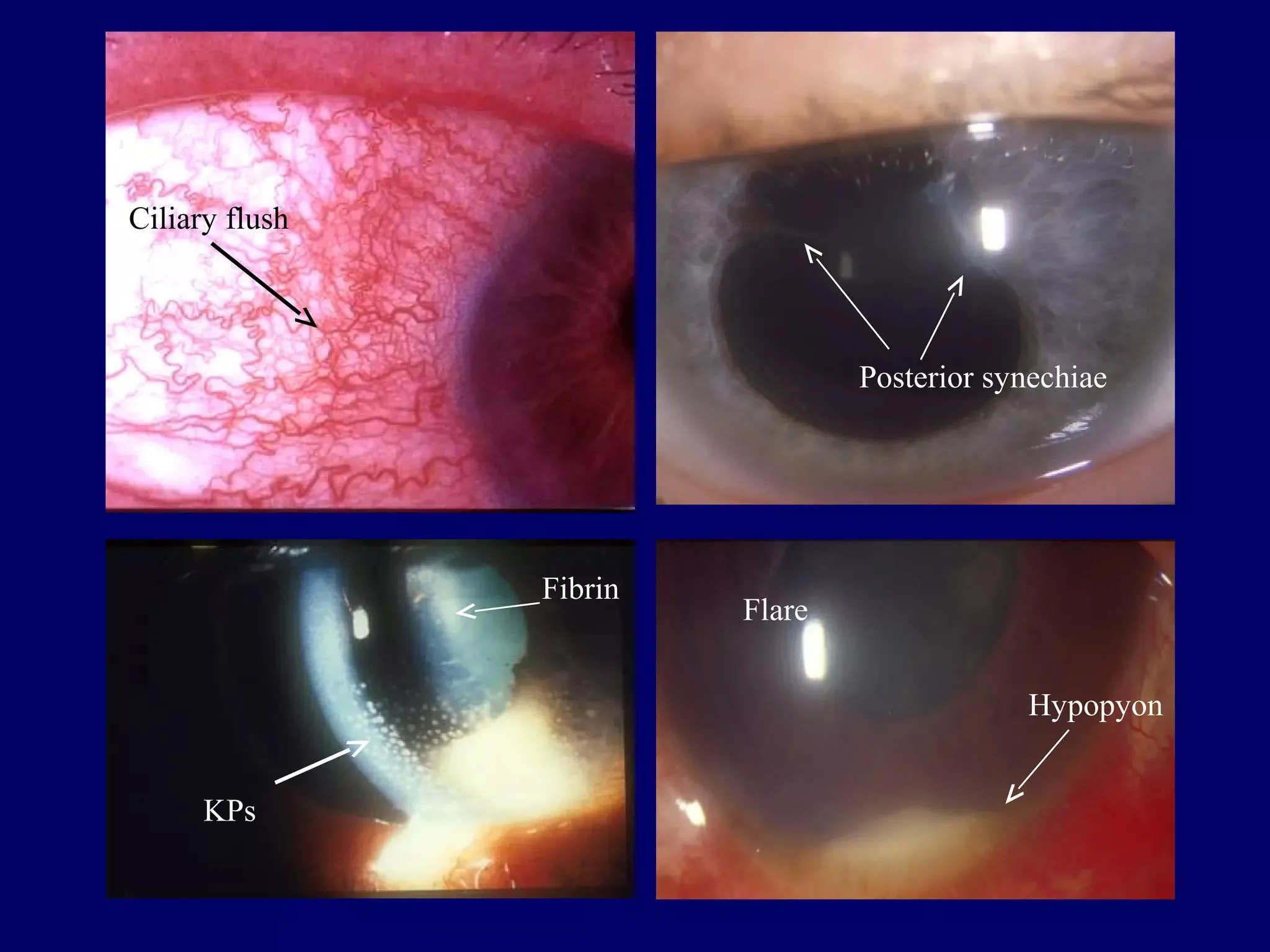 Ciliary flush and anterior chamber reaction