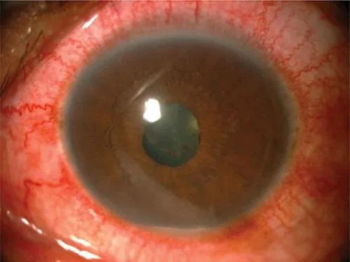 HLA-B27 Uveitis: Severe fibrinous reaction
