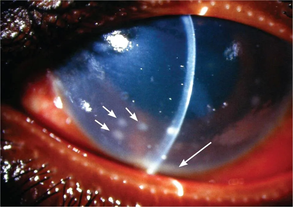 Hypopyon Uveitis (Layer of white blood cells inferiorly)