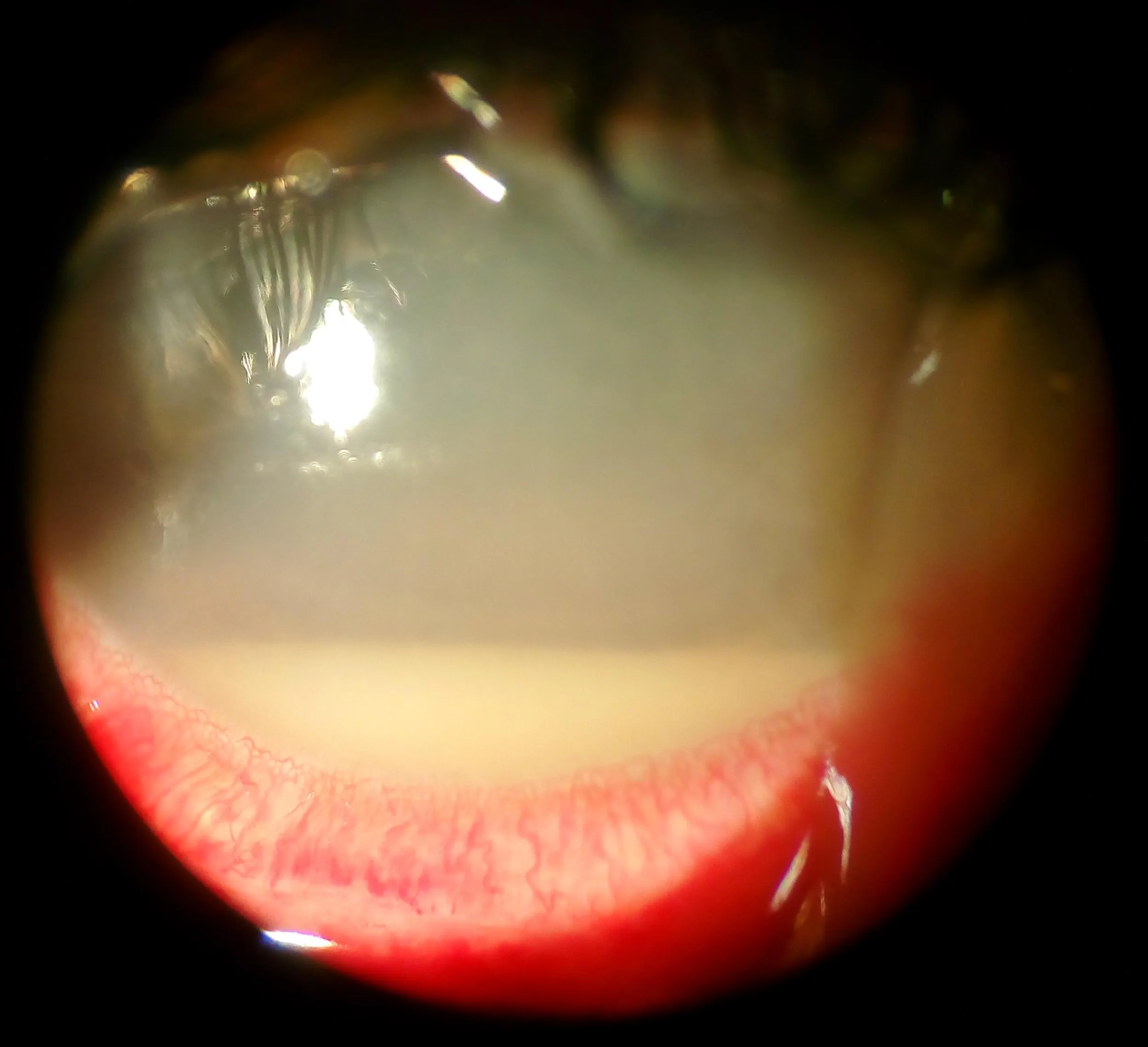 Severe Hypopyon measuring several millimeters