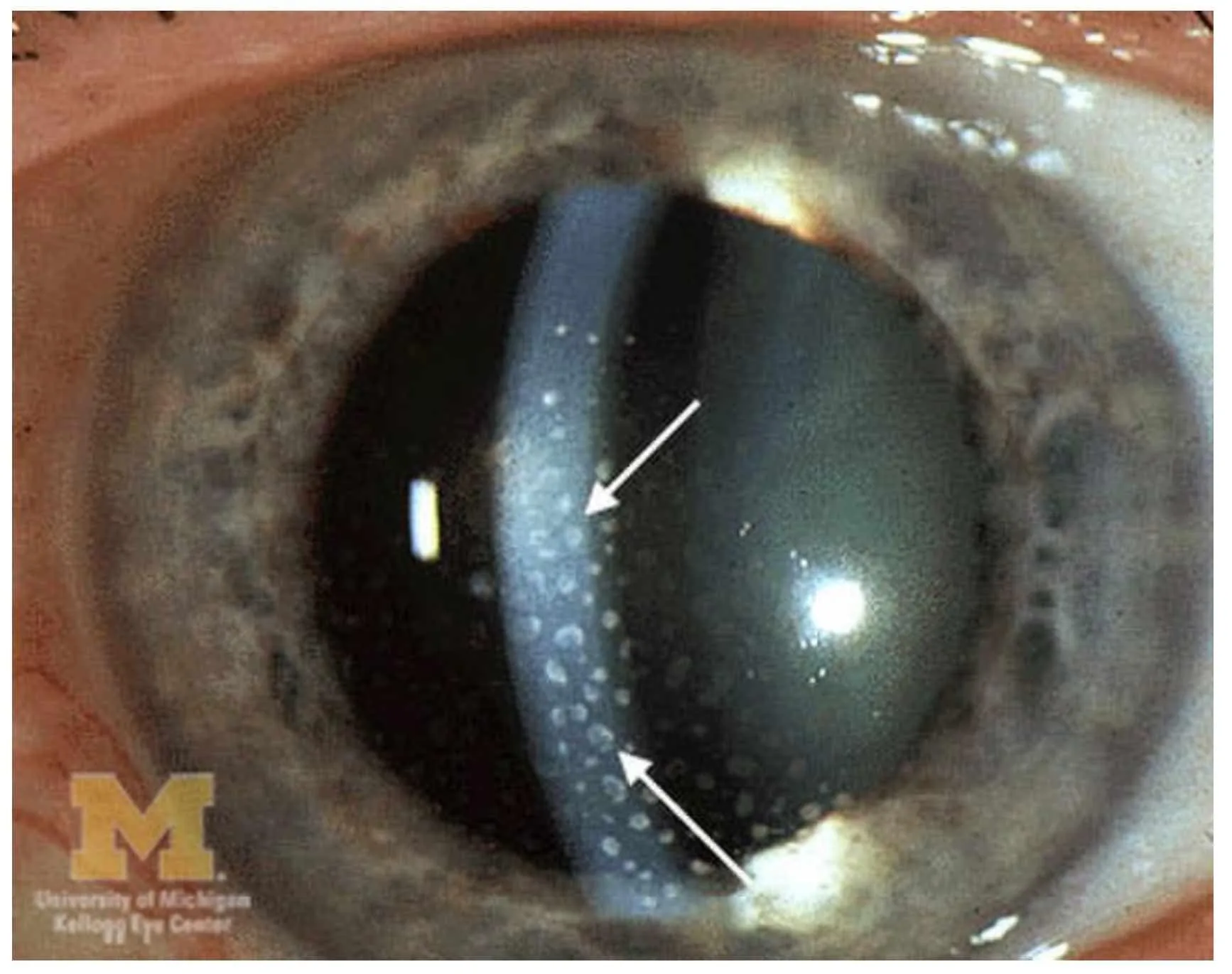 Granulomatous Uveitis: Mutton-Fat Keratic Precipitates