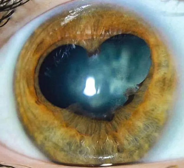 Irregular pupil (Festooned pupil) due to synechiae